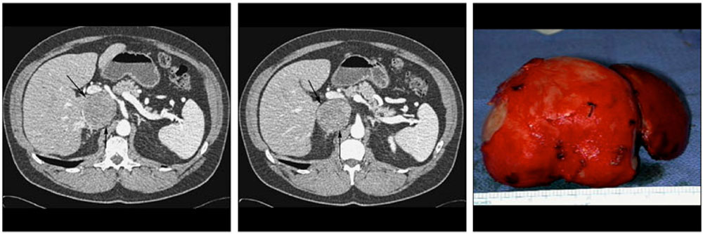 Primary tumor of the IVC